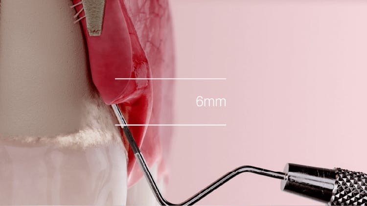 Imagen de diente y encías mostrando periodontitis