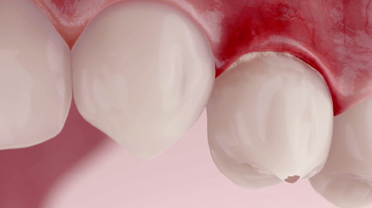 Imagen de dientes y encías mostrando gingivitis