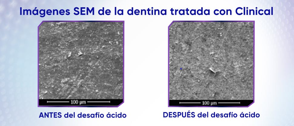 Imágenes de dentina tratada con la crema dental Sensodyne Clinical Repair antes y después del desafío ácido para mostrar resistencia