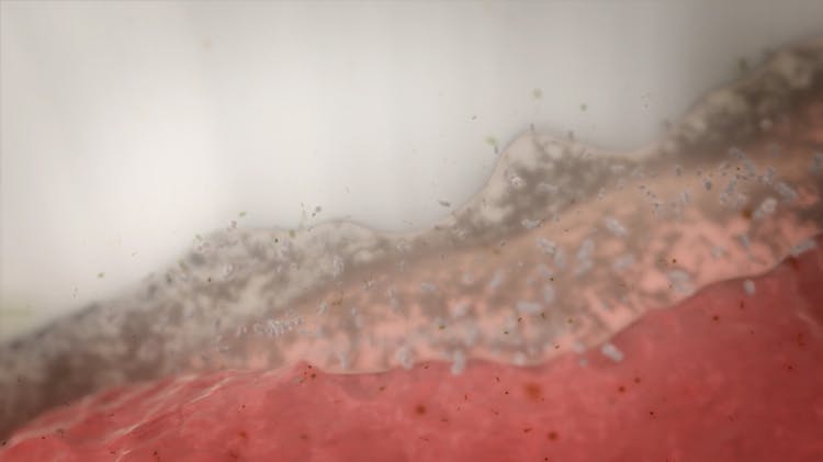 Captura de video de estomatitis protésica