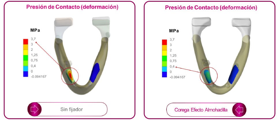 Comparación de la presión de contacto con y sin fijador