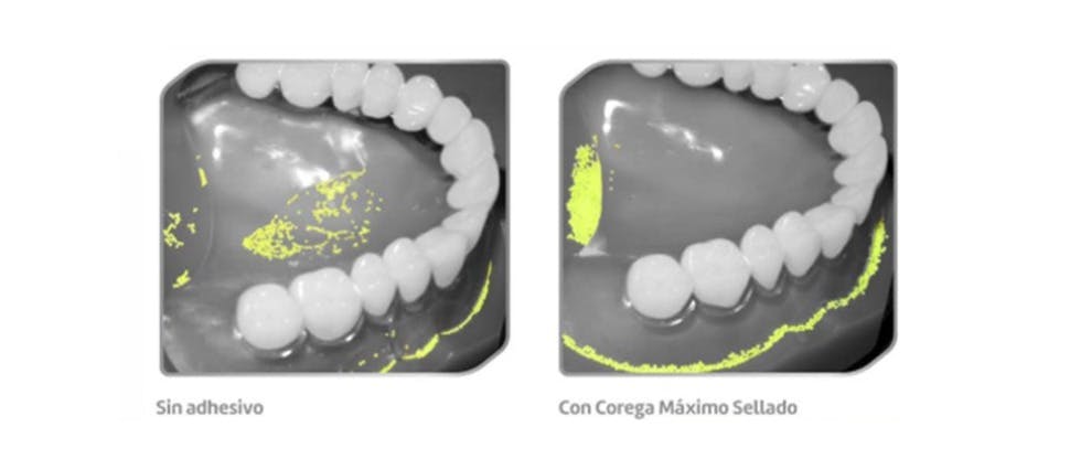 Imágenes de atrapamiento de alimentos sin y con fijador  Corega 