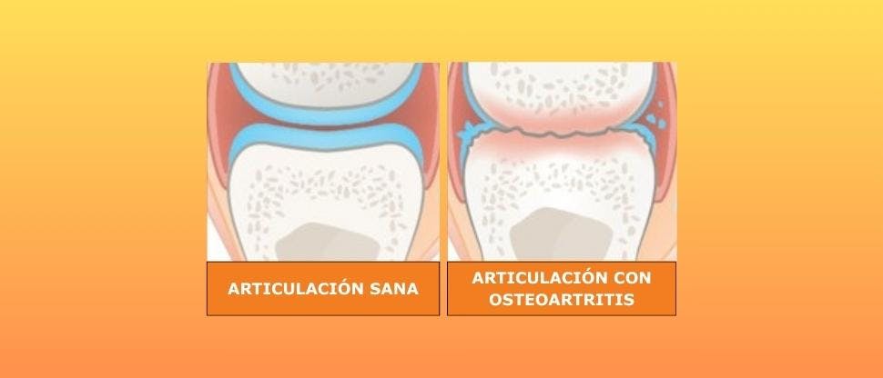 Osteoartritis