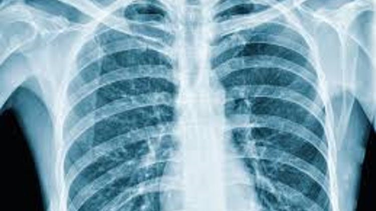 Foto radiografia torax con neumonia