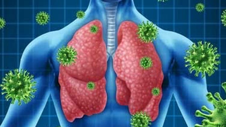 Imagen pulmones infección IRAS