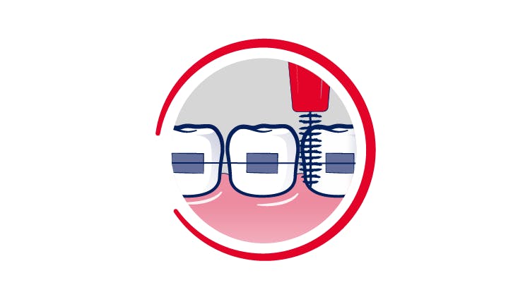 Nettoyage des appareils dentaires