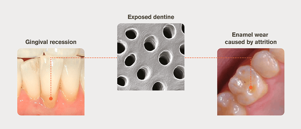 Causes de la dentine exposée