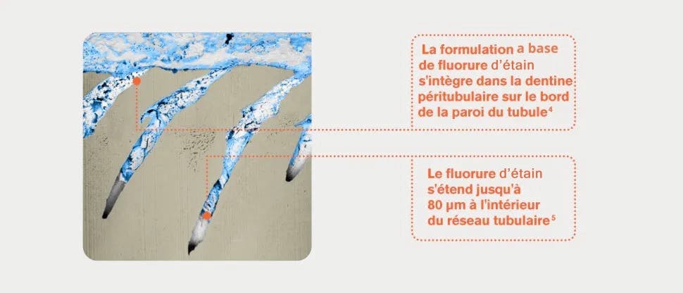Sels d'étain insolubles adhérant à la dentine
