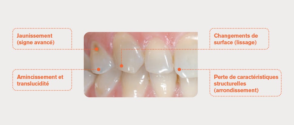 Dents présentant une usure de l'émail