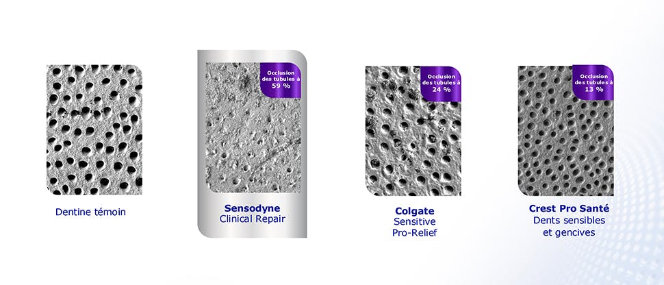 Image de tubules dentinaires après un traitement par dentifrice