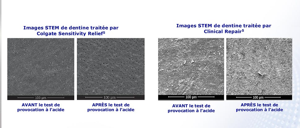 Images de dentine traitée par le dentifrice SENSODYNE Clinical Repair et le dentifrice Colgate Sensitivity Relief avant et après un test de provocation à l’acide visant à montrer la résistance de la protection