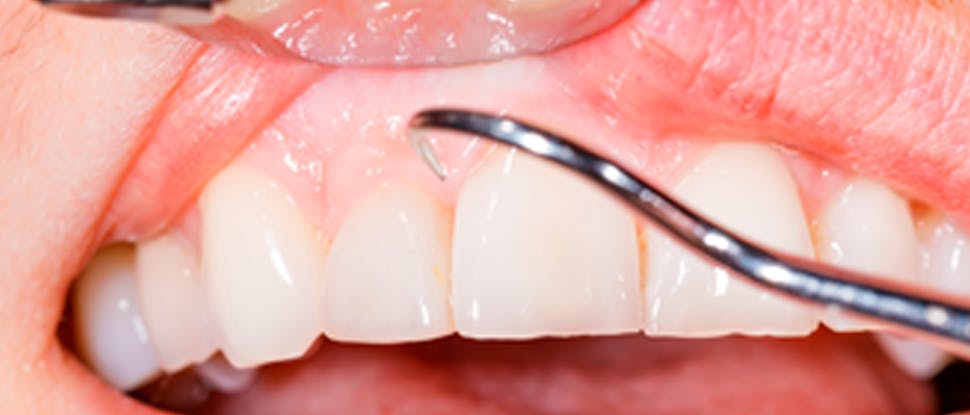 Causes de la dentine exposée