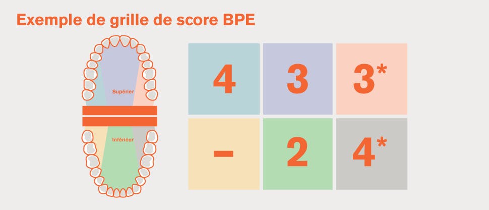 Division EPB de la dentition en sextants et exemple de grilles