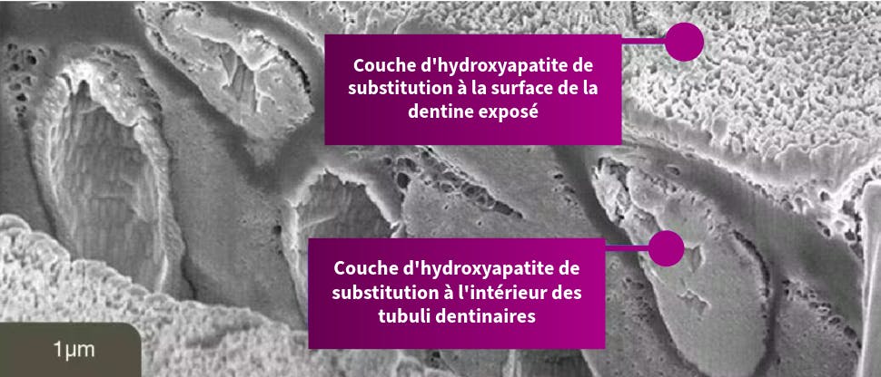 La NovaMin crée une couche d’hydroxyapatite de substitution sur la dentine exposée 