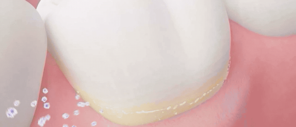 Image d'un consommateur buvant de l'eau glacée réagissant à des dents sensibles