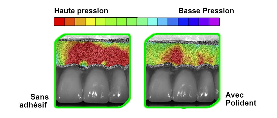 Réduction de la pression sur les gencives grâce à l'utilisation de l'adhésif Polident