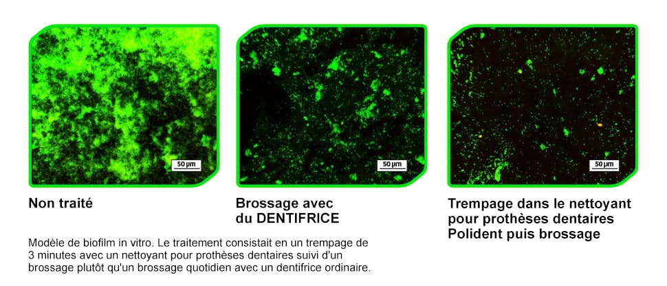 Images montrant comment le trempage de l'appareil dans Polident élimine davantage de bactéries et de levures que le brossage avec du dentifrice.