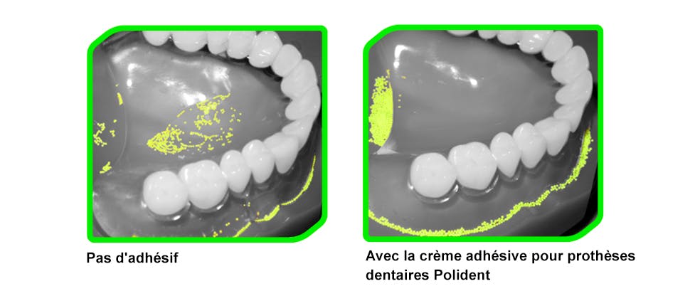 Images de piégeage d'aliments avec et sans adhésif Polident