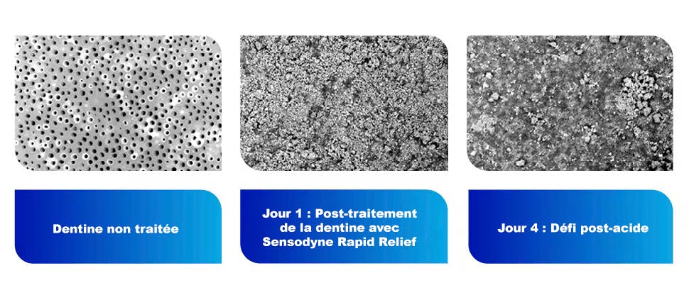 Images en gros plan de la dentine avant et après un traitement au fluorure stanneux