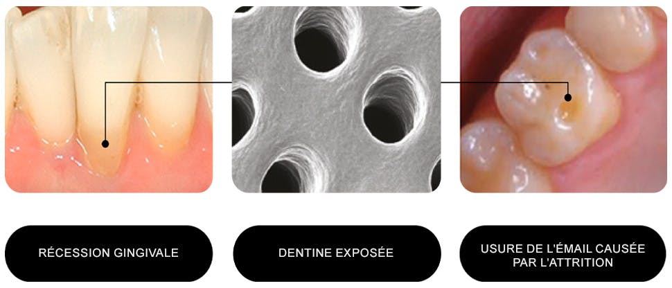 Causes de la dentine exposée