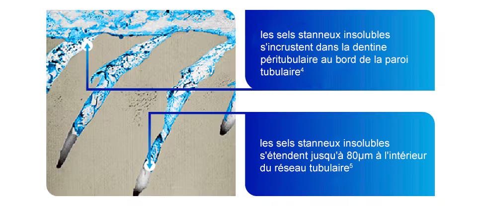 Sels stanneux insolubles s'incrustant dans la dentine