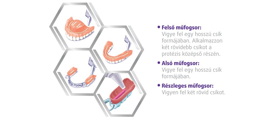 Kép a műfogsorrögzítő alkalmazásáról különböző műfogsorokra