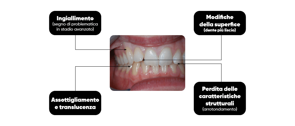 Caratterisitche dell’erosione dello smalto