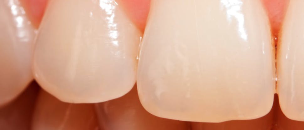 Immagine ravvicinata di denti con erosione dello smalto