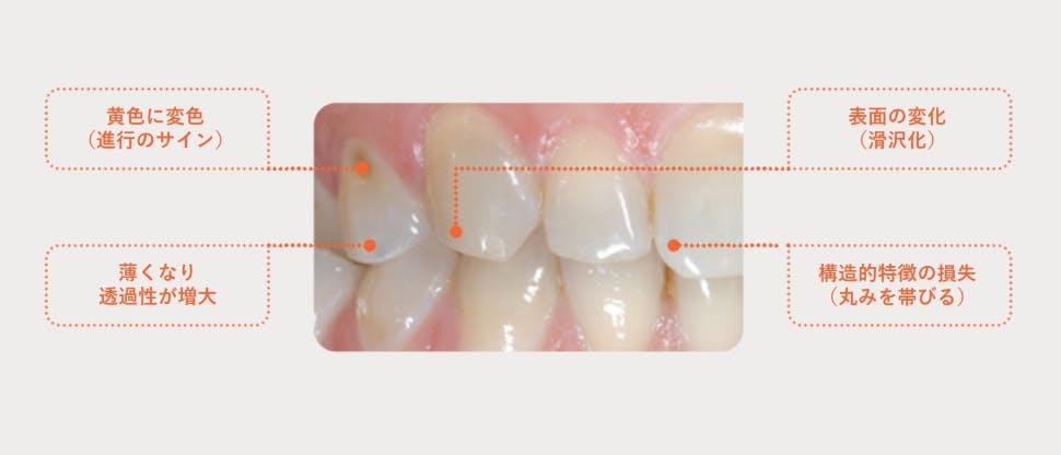 エナメル質損耗の初期サイン