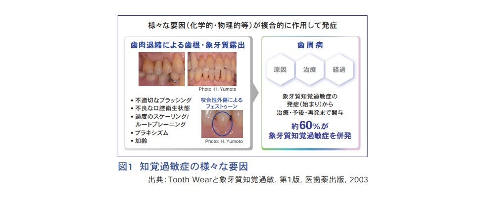 知覚過敏症の様々な要因