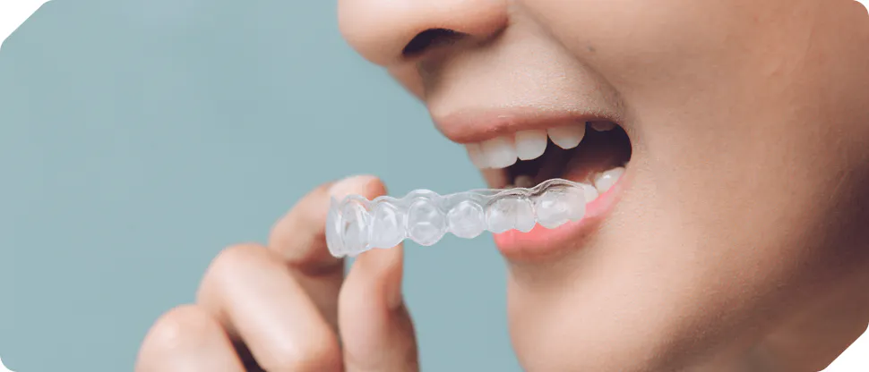 image for wearing retainer