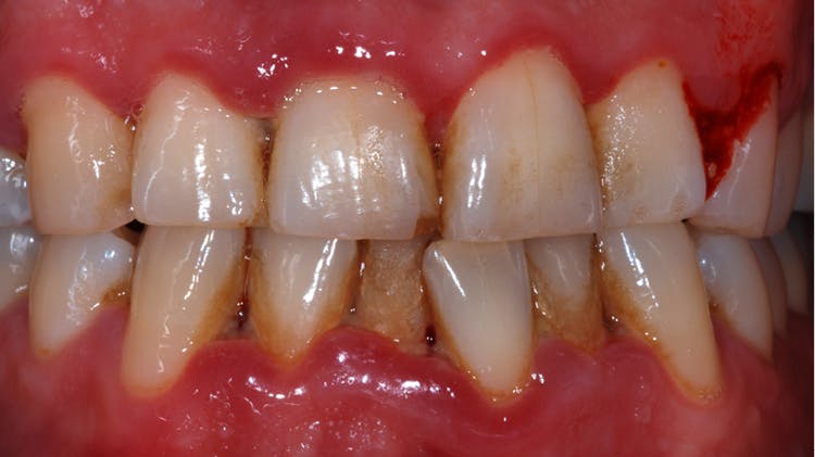 괴사성 궤양성 치은염 및 괴사성 궤양성 치주염