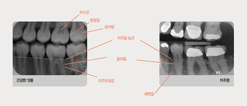 자세한 치주 차트