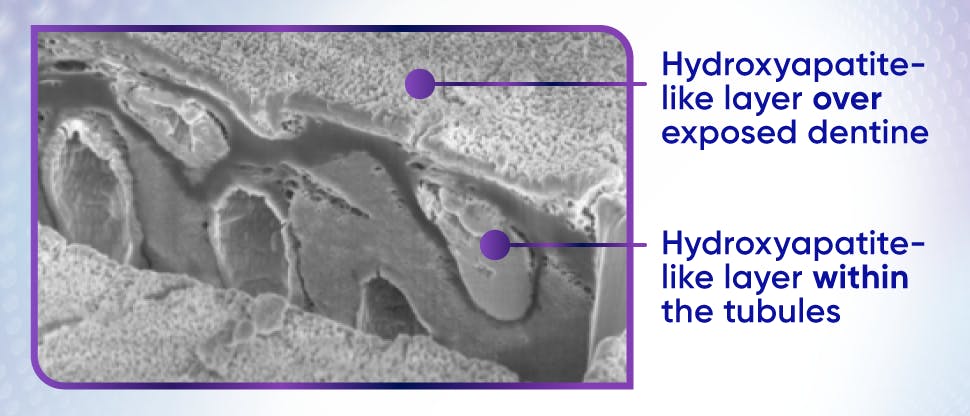 SEM image of hydroxyapatite-like layer over exposed dentine