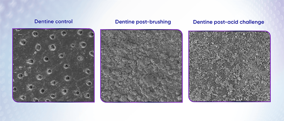 Scanning electron microscope (SEM) images of dentine surface showing layer formed post brushing retained after acid challenge