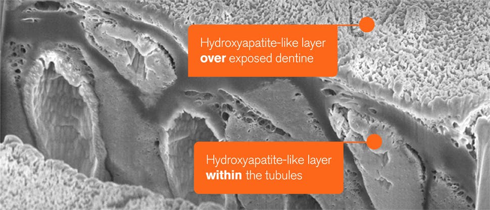 SEM-afbeelding van hydroxyapatiet-achtige laag over blootliggend dentine