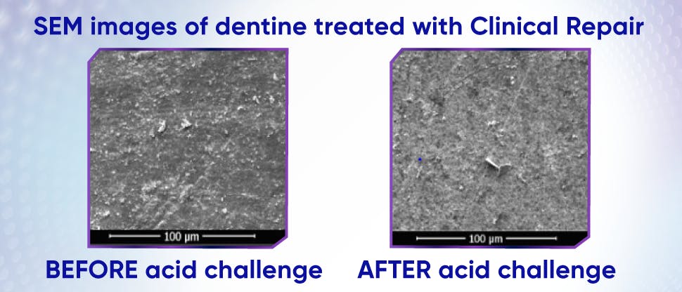 Afbeeldingen van tandbeen behandeld met Sensodyne Clinical Repair voor en na zuurtest om resistentie te tonen