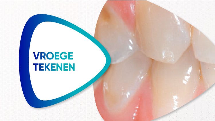 Afbeelding van eerste tekenen van tandslijtage