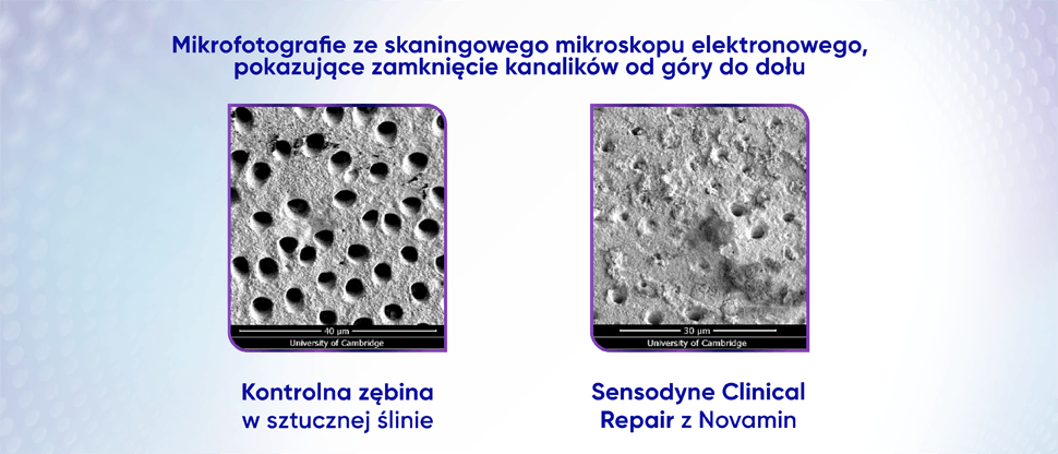 Obraz kanalików zębinowych po kuracji z zastosowaniem pasty do zębów