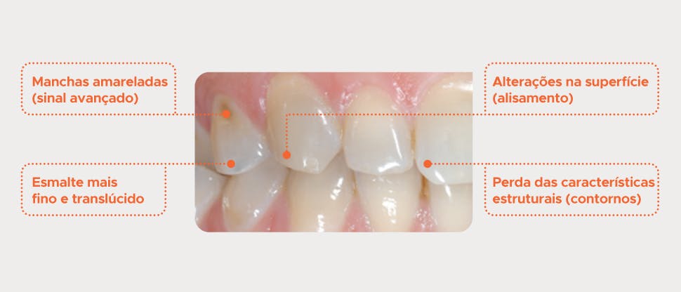 Dentes com desgaste do esmalte