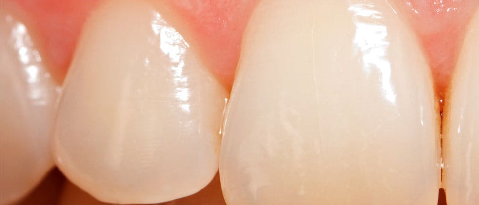 Dentes com desgaste do esmate