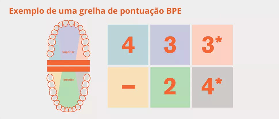 Divisão da dentição BPE em sextante e exemplo grelha