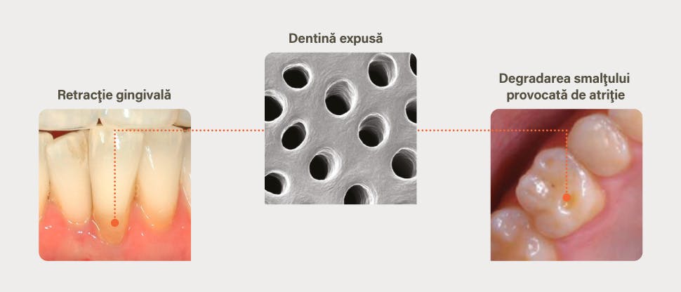 Cauzele expunerii dentinei