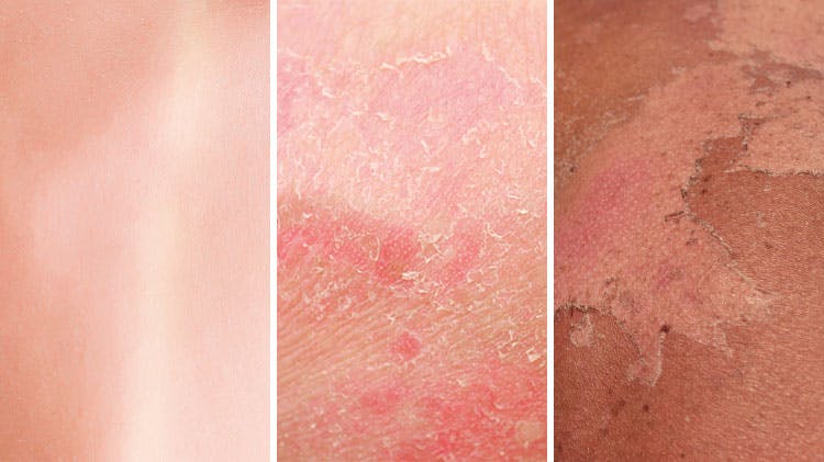 Аллергия на солнце: как выглядит, как проявляется и чем лечить