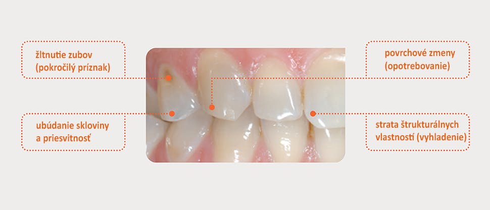 Obvyklé znaky opotrebovania zubnej skloviny
