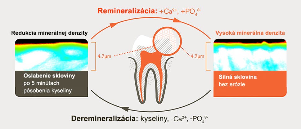 Proces demineralizácie a remineralizácie po 5 minútach pôsobenia kyselín