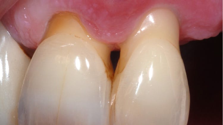 Parodontálny abces