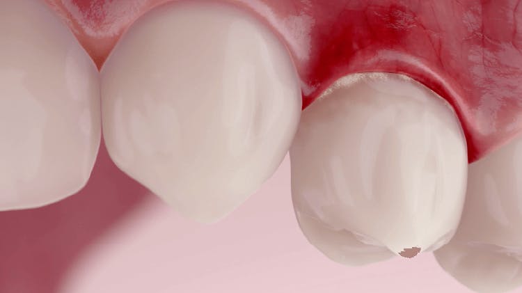 Slika zuba i desni koja prikazuje gingivitis