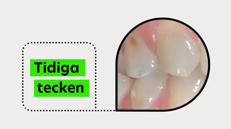 Tidiga tecken på emaljskador