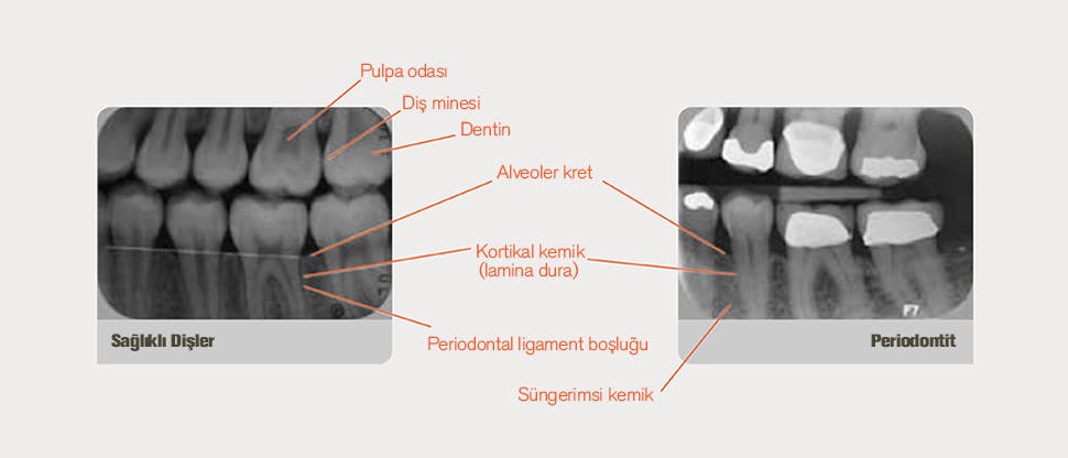 Açıklamalı röntgen
